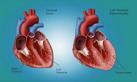 lv due|Left ventricular hypertrophy .